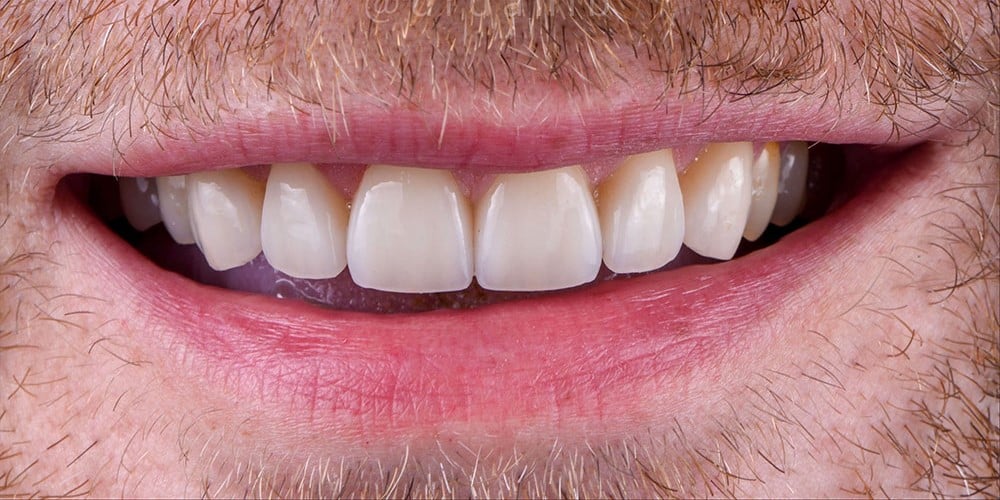 After image