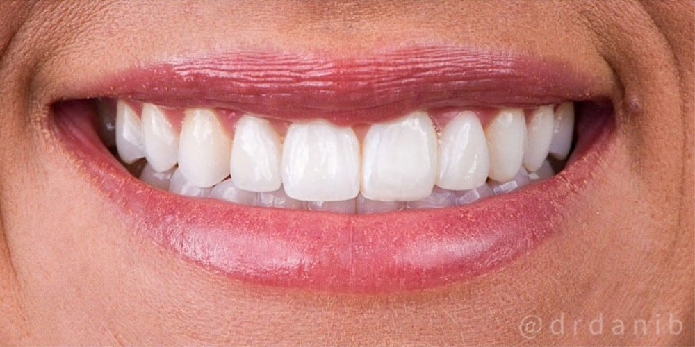 After image
